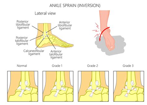 Medial Ankle Sprain