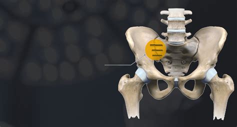 Sacroiliac Joint Fusion