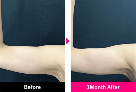 小顔用脂肪吸引注射｜脂肪吸引なら湘南美容クリニック【公式】