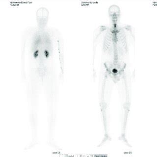 Image result for Radionuclide Scan