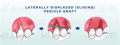 Pedicle Grafts in Periodontics: A Comprehensive Guide – Mr Bur