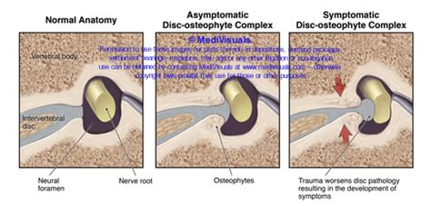 Disc-Osteophyte Complex Explained