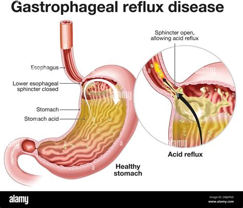 Illustration showing Gastrophageal reflux disease (GERD) is a digestive ...