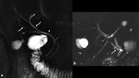 Image result for MRCP Biliary Tree