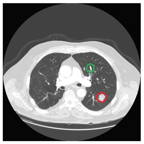 Node In Lung Ct Scan