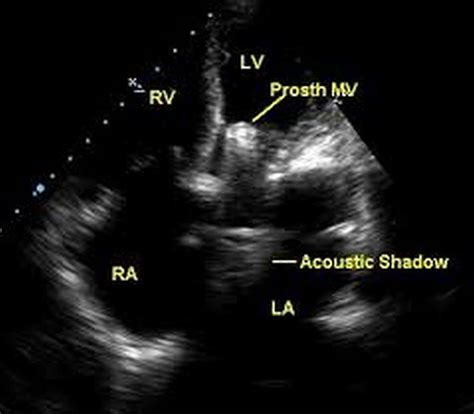 Mitral Valve Anatomy Echo at Sally Seim blog