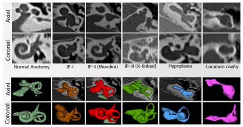 A New Pathogenic Variant in POU3F4 Causing Deafness Due to an ...