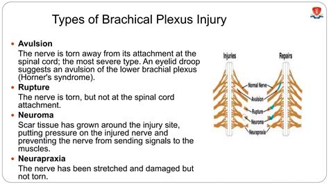 Brachial plexus injury | PPTX | First Aid | Injuries