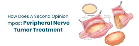 How a Second Opinion Can Impact Peripheral Nerve Tumor