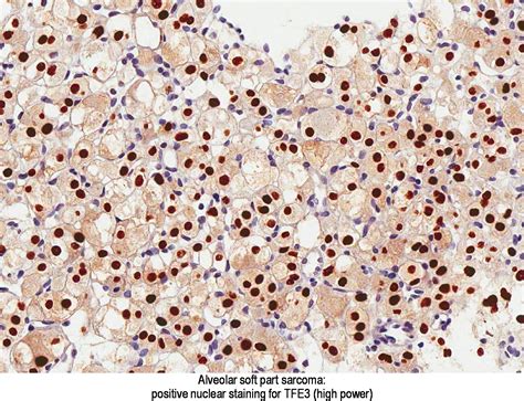 Pathology Outlines - Alveolar soft part sarcoma