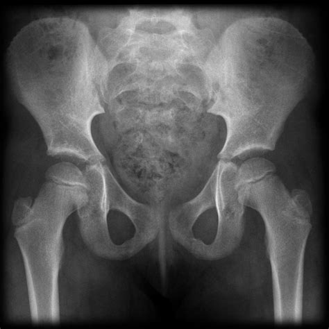 Anatomy Of Hip X Ray at Earl Bremer blog