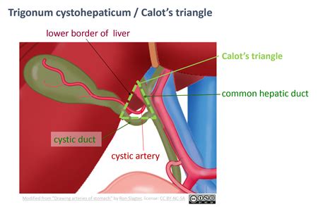 Leiden - Drawing Calot's triangle - English labels | AnatomyTOOL