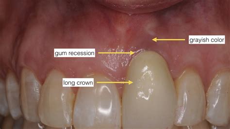 Receding Gums Molar
