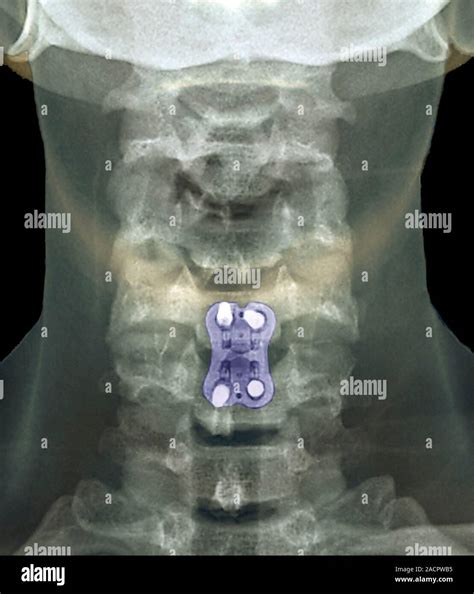 Neck arthritis treatment. Coloured X-ray of the neck of a 48 year old ...