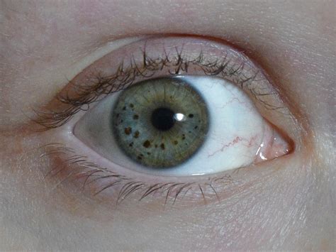 Brown Speck In Eye