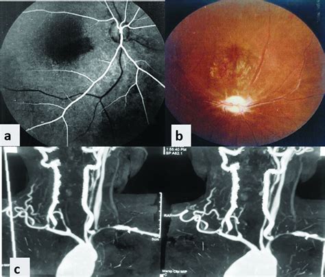 Causes Of Transient Binocular Vision Loss at Andrew Godina blog