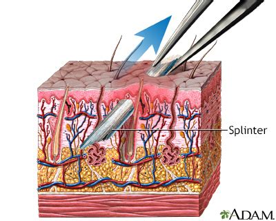 Image result for How to Get an Embedded Splinter Out