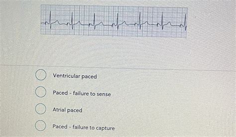 Solved Ventricular paced Paced - failure to sense Atrial | Chegg.com