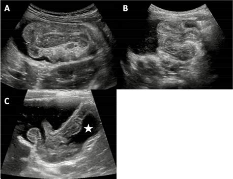 Intussusception Ultrasound Protocol