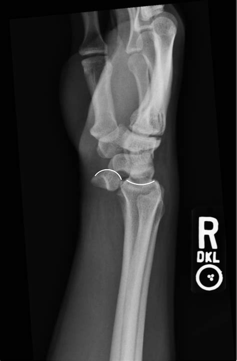 Image result for Lunate Dislocation Reduction