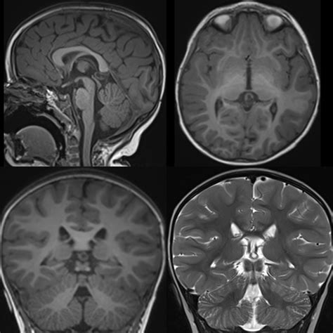 Pediatric Pineal Cyst | Pediatric Radiology Reference Article | Pediatric Imaging | @pedsimaging