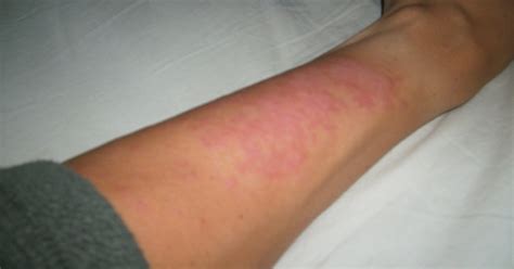 What Does A Sun Allergy Rash Look Like at Alan Rayl blog