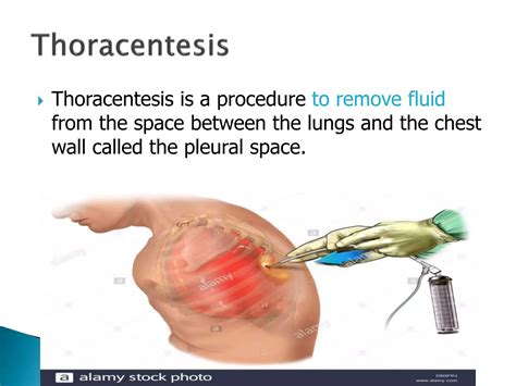 Clinical presentation of a patient with pleural effusion | PPTX