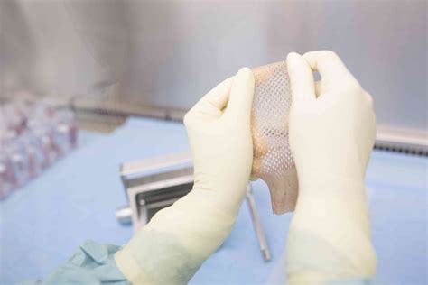 Skin Graft Surgery Process at Karen Evans blog