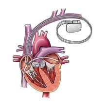 Pacemaker Procedure 的图像结果