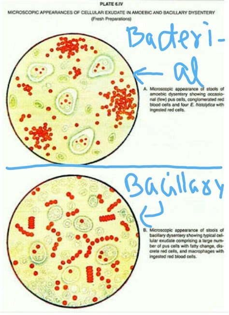 Difference between bacillary and bacterial dysentery - Brainly.in