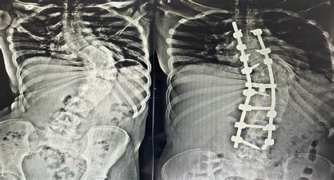 ⁠Best Scoliosis and Kyphosis Correction Surgeon in Chennai