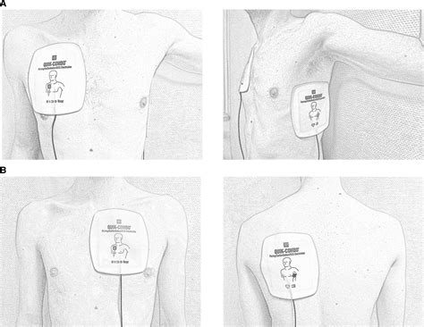 Electrode Placement Defibrillation at Jake Burdekin blog