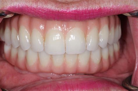 What Is Zirconia In Dentistry at Eileen Marvin blog