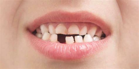 Image result for Lost Tooth