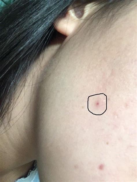 Image result for Blood Red Pimple