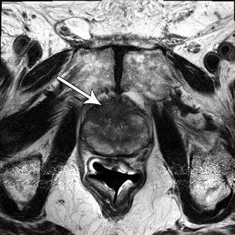 Multiparametric MR Imaging of the Prostate after Treatment of Prostate ...
