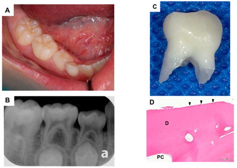 Ankylosed Primary Molar in a Japanese Child with Hypophosphatasia
