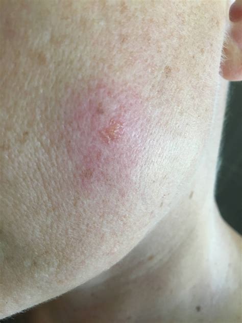 White Tail Spider Bite Spider Bites – All You Need To Know! AllPro