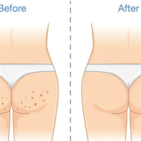 Stream Common Causes Of Butt Acne And How To Treat Them Effectively by Skin Boss | Listen online ...