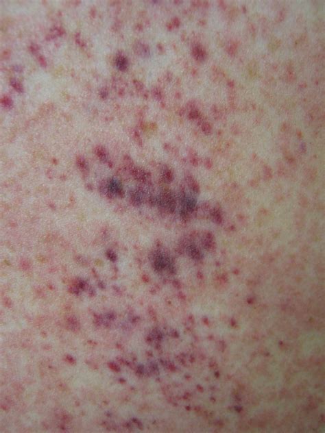Petechiae: Causes, Pictures, and When To Worry