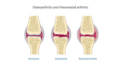 New 3D bio-material could help reverse arthritis