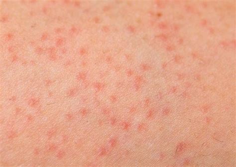 Folliculitis Solutions & Laser Hair Reduction Tips - Blog