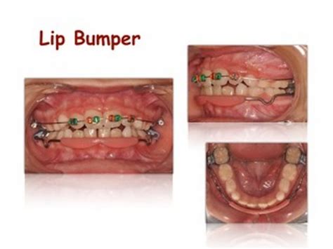 Ortodoncia Borja | Respuestas a las dudas más frecuentes en un ...