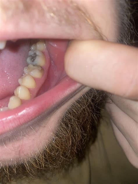 Image result for Grey Tooth