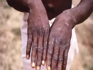Suspected case of monkeypox reported in Karnataka - The Economic Times