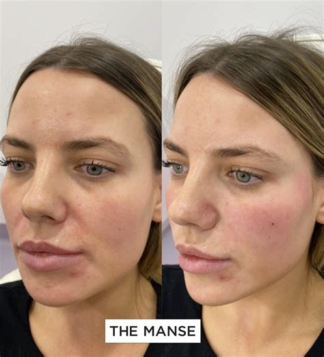 Nasolabial Fold Filler; Expert doctors injecting at our Sydney clinic