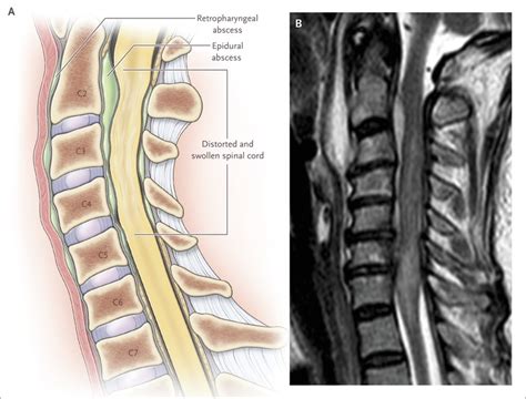 Spinal Cord Compression 的图像结果