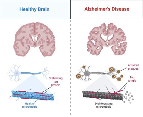 Alzheimers Disease Causes