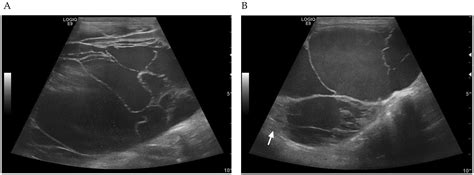 Feline Cyst-like Lymphocytic Cholangiohepatitis in a Cat: First Case Report