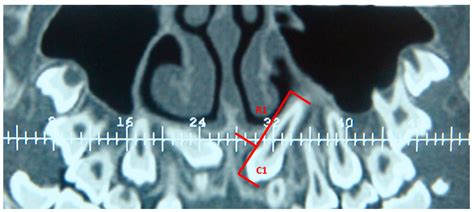 Cone Beam Computed Tomography (CBCT) Aid in the Management of Apical ...